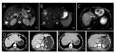 Solid pseudopapillary neoplasm of the pancreas with hepatic metastases: problems and strategies